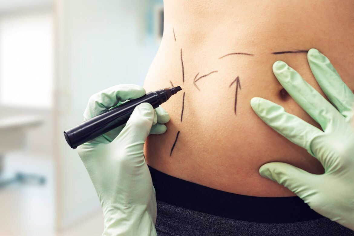 How is liposuction surgery done?