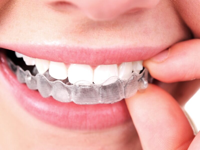 Sports and braces: How can Invisalign help you?