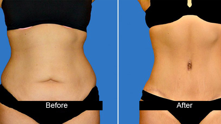 Best Surgeon for Tummy Tuck in Punjab